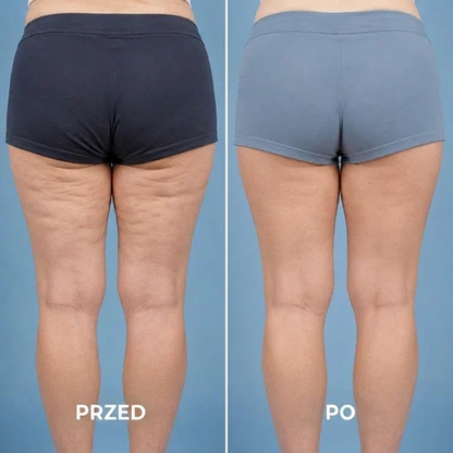 Shape Treatment – masażer przeciwcellulowy na brzuch, nogi i pośladki